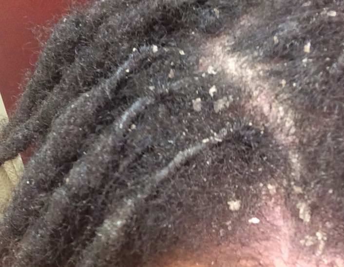 Understanding and Alleviating Itchy Scalp: A Comprehensive Guide